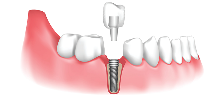 implant dentaire tunisie