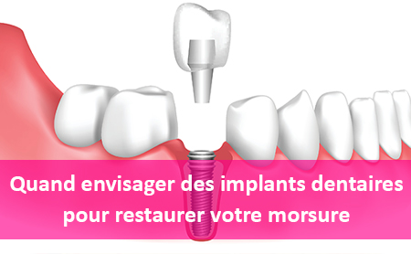 implant-dentaire-Tunisie