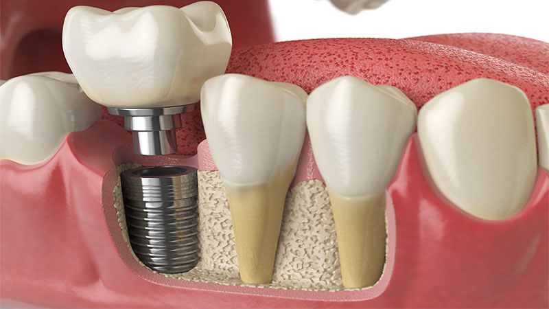 Implants Dentaires Tunisie
